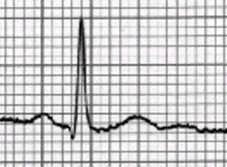 INTERPRETACIÓN DE ELECTROCARDIOGRAMA